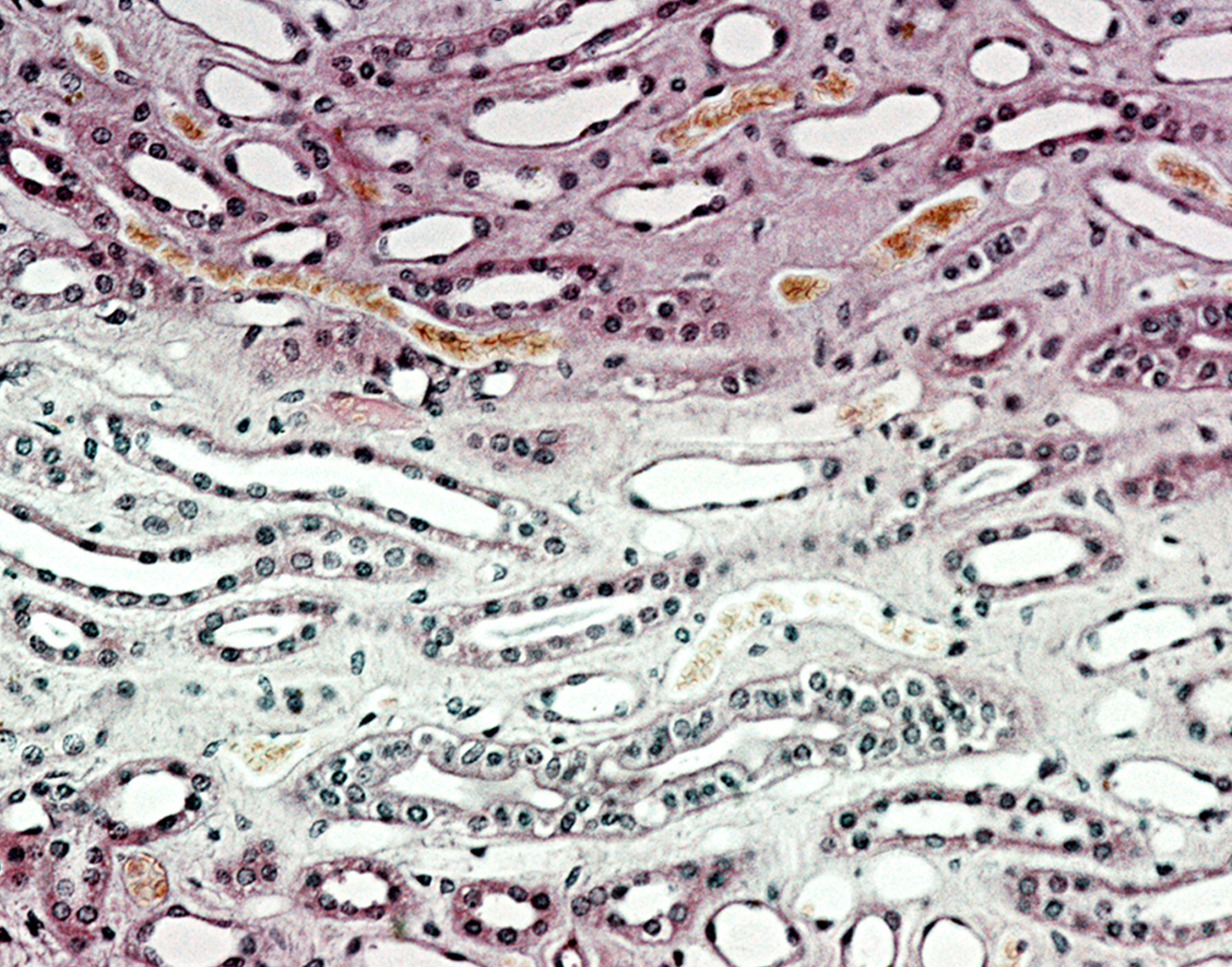 ureteral-retrograde-brush-biopsy-708x556-2x