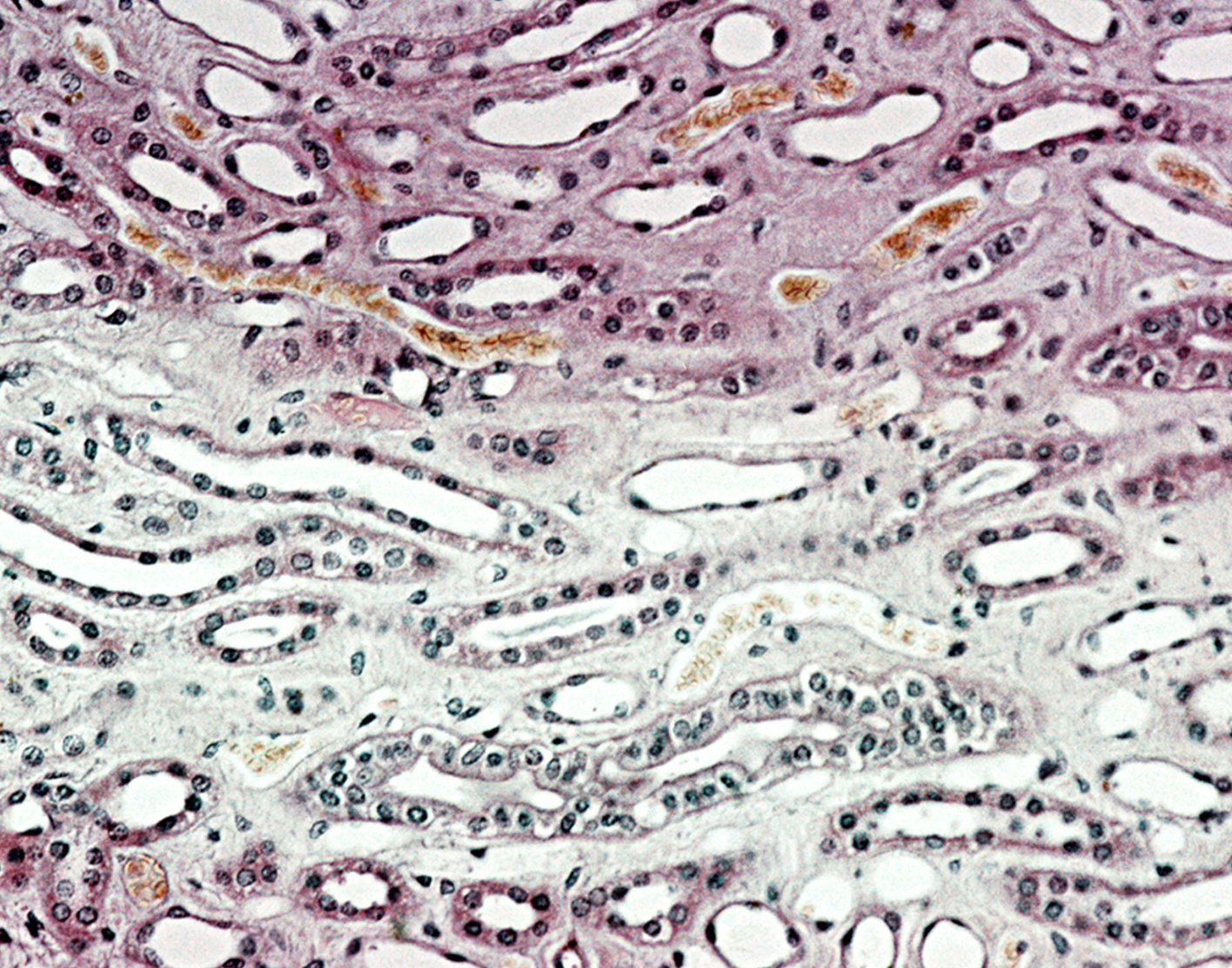 ureteral-retrograde-brush-biopsy-708x556-2x