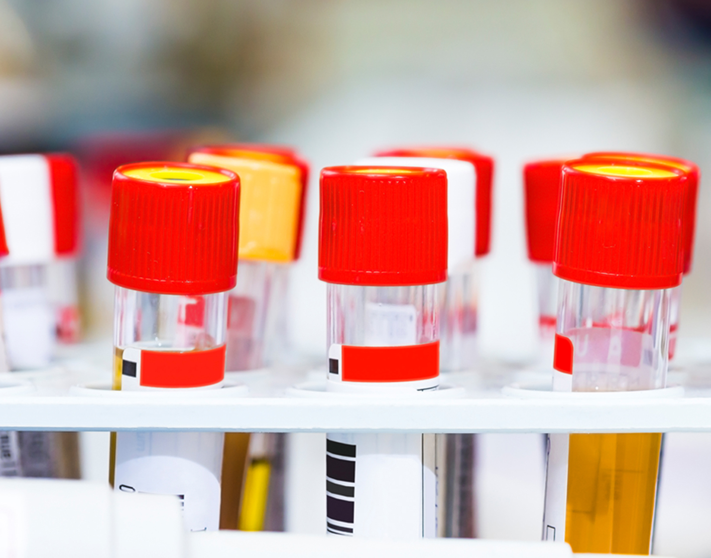 uric-acid-urine-test-708x556-2x