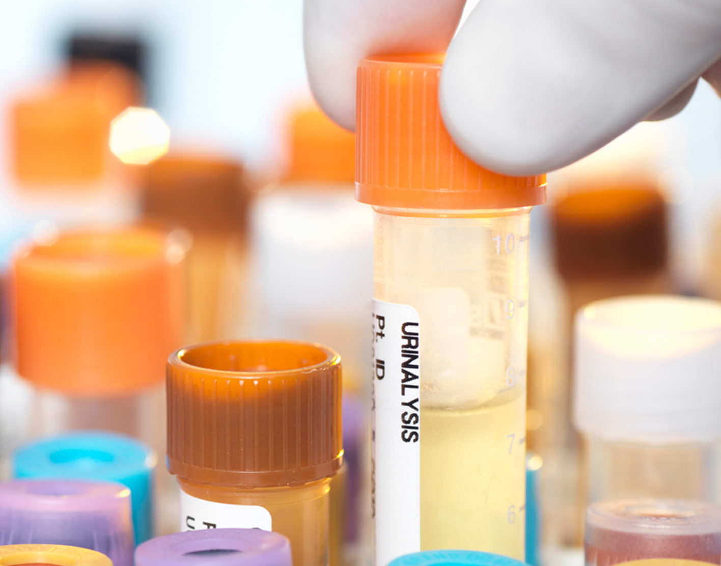 urinalysis-708x556-2x