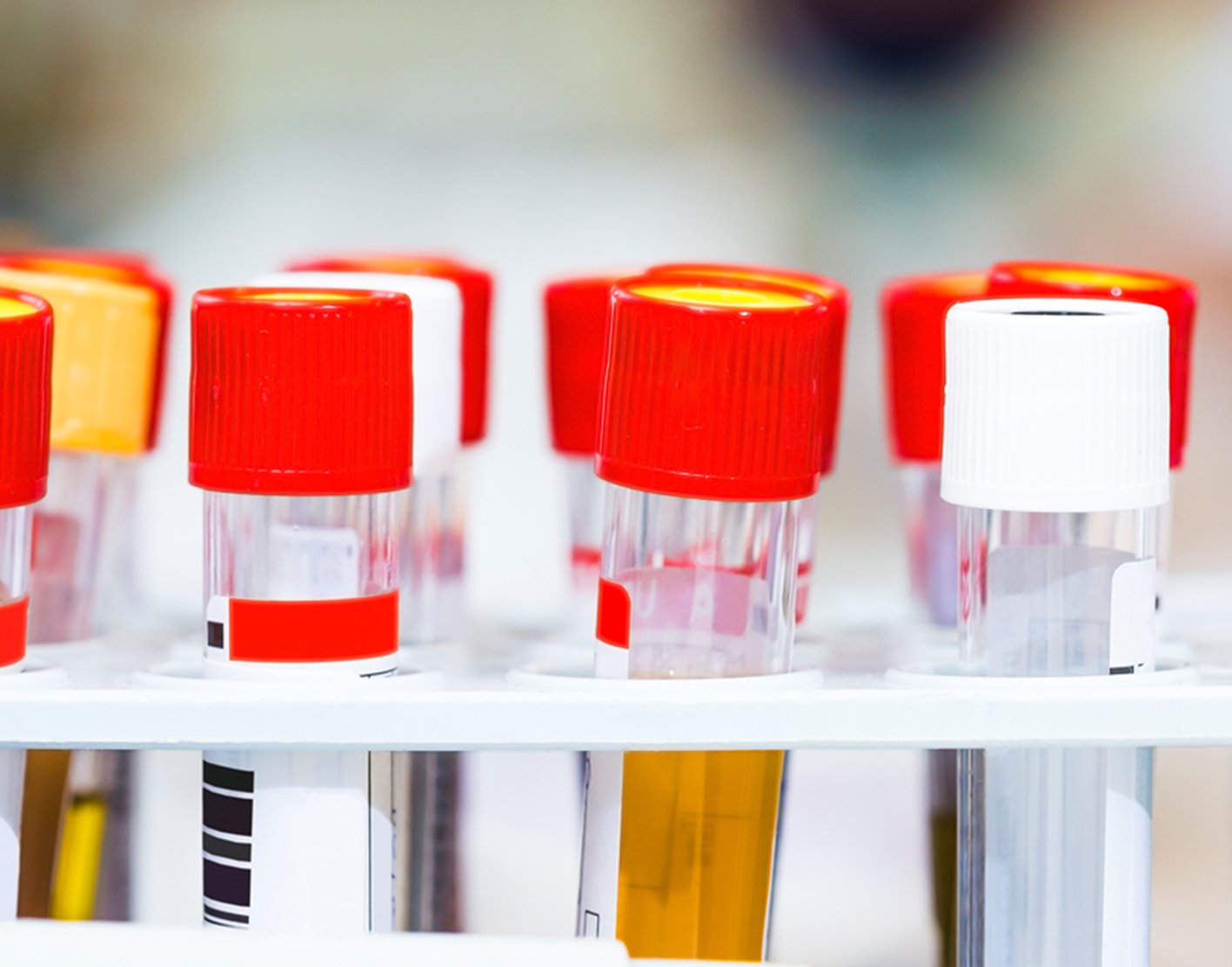 urine-concentration-test-708x556-2x