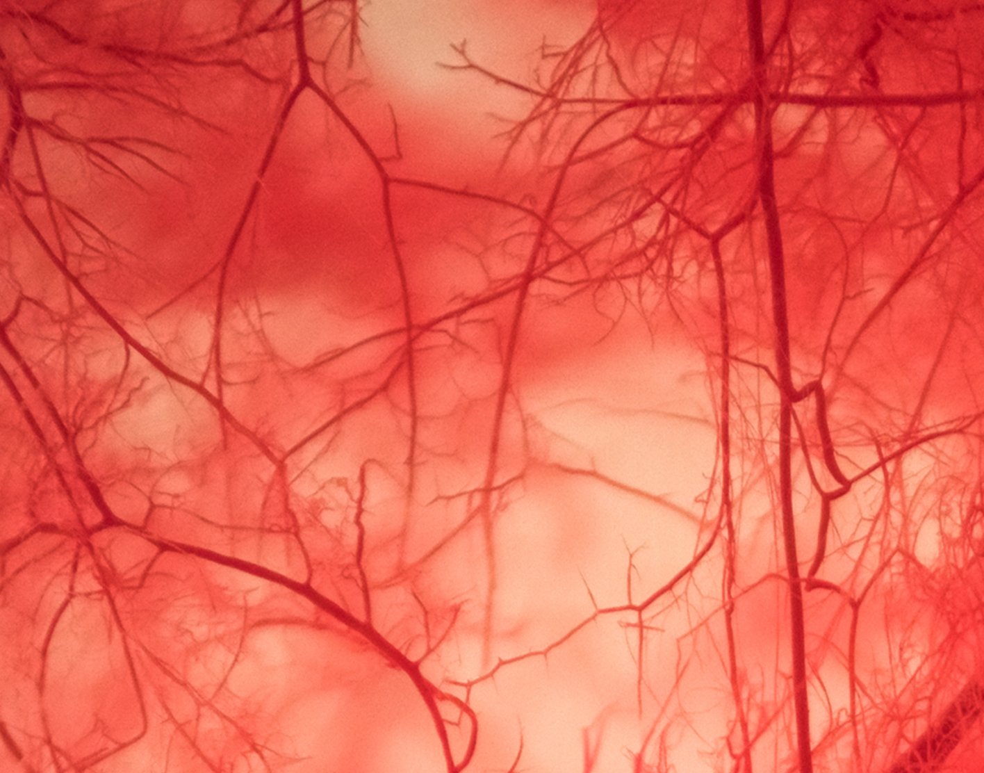 venogram-708x556-2x