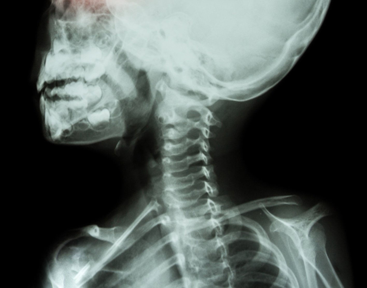 X-ray - skeleton
