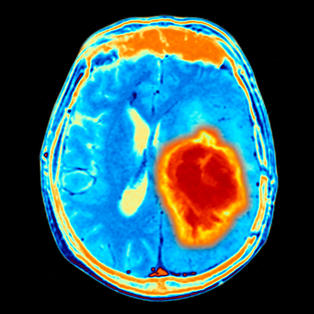 ucsf-brain-tumor-center-clinical-trials-2x