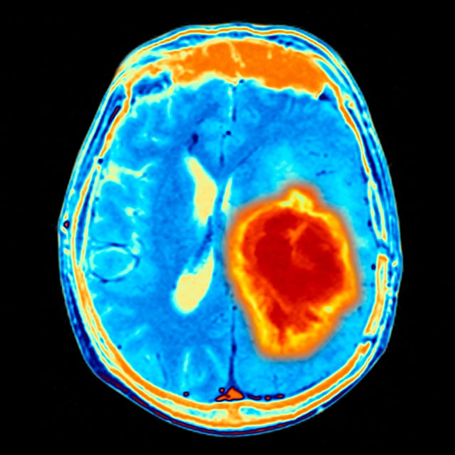 ucsf-brain-tumor-center-clinical-trials-2x