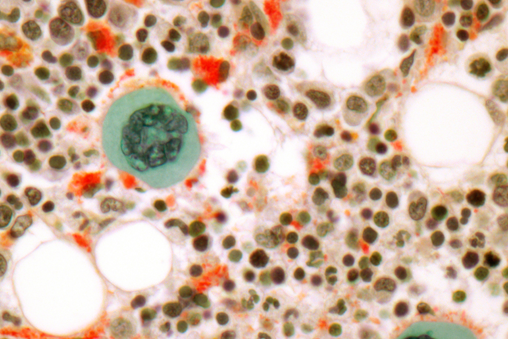 blood-and-marrow-transplant-2x