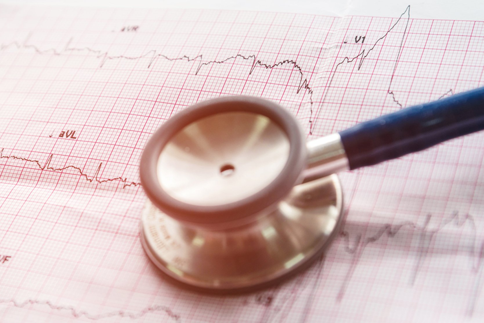 electrophysiology-study-and-catheter-ablation-2x