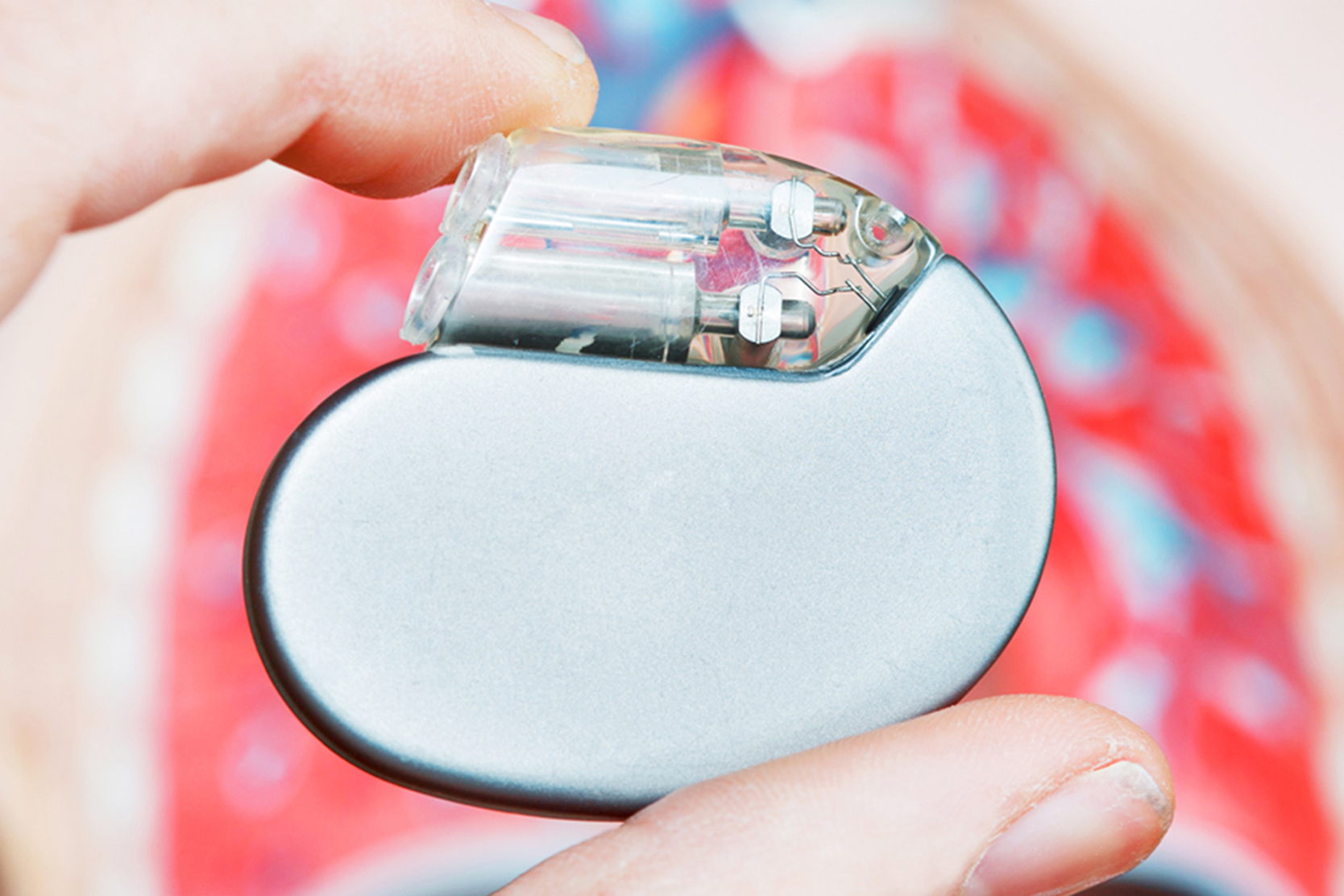 implantable-cardioverter-defibrillator-procedure-2x