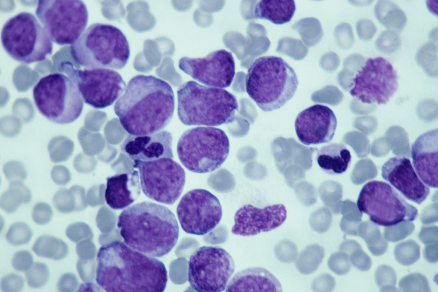 leukemia-treatment-options-2x