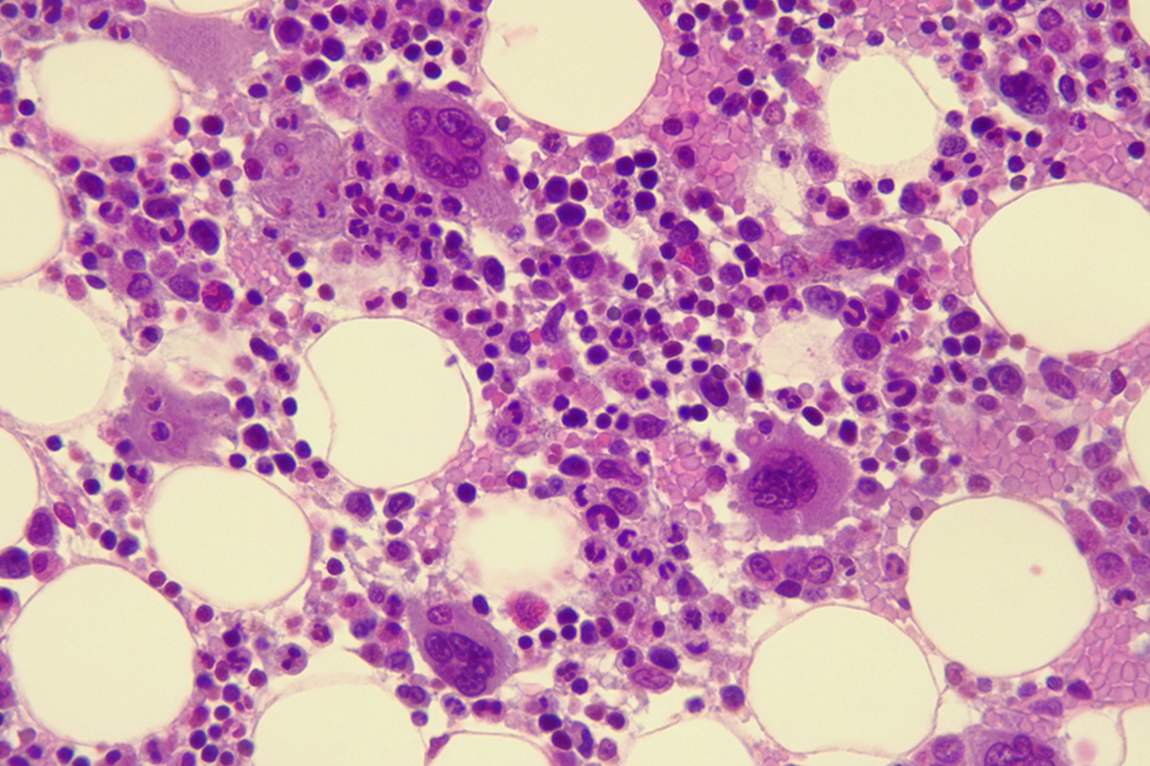 specific-bone-marrow-transplant-treatment-options-2x