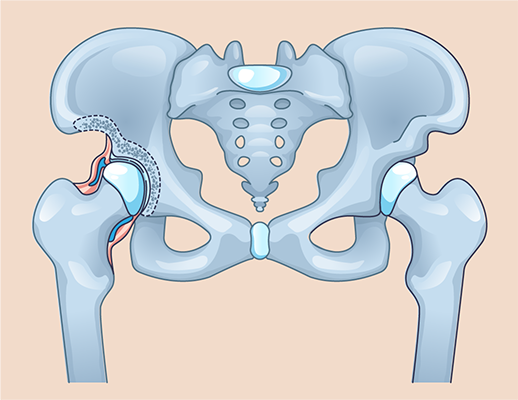 An illustration depicting hip dysplasia. The hip joint on the right side of the image has a shallow socket requiring PAO surgery